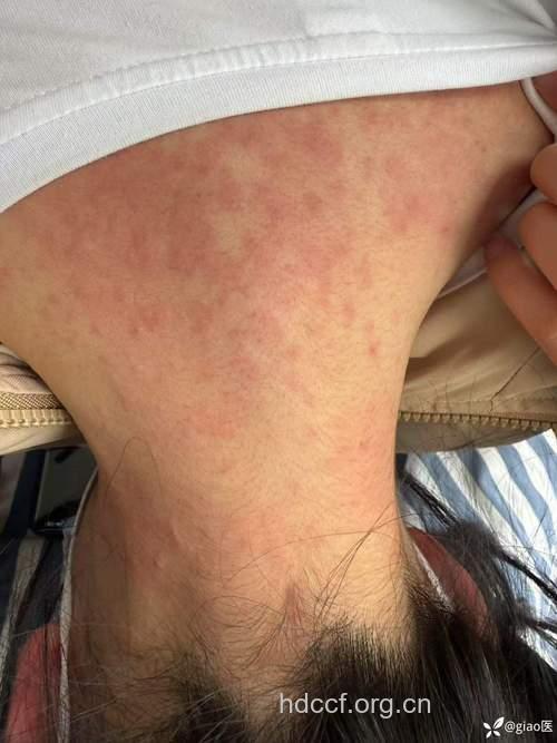 女人容易春季皮炎骚扰