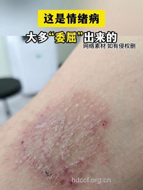 心理压力也会可能导致皮炎湿疹