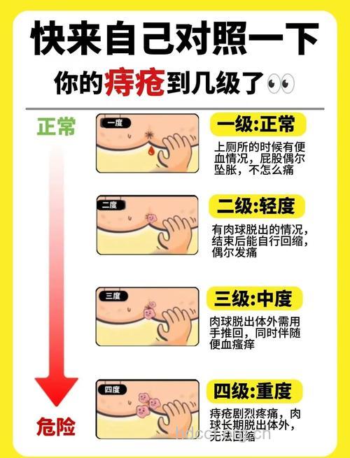 疾病百科 外痔的症状及治疗