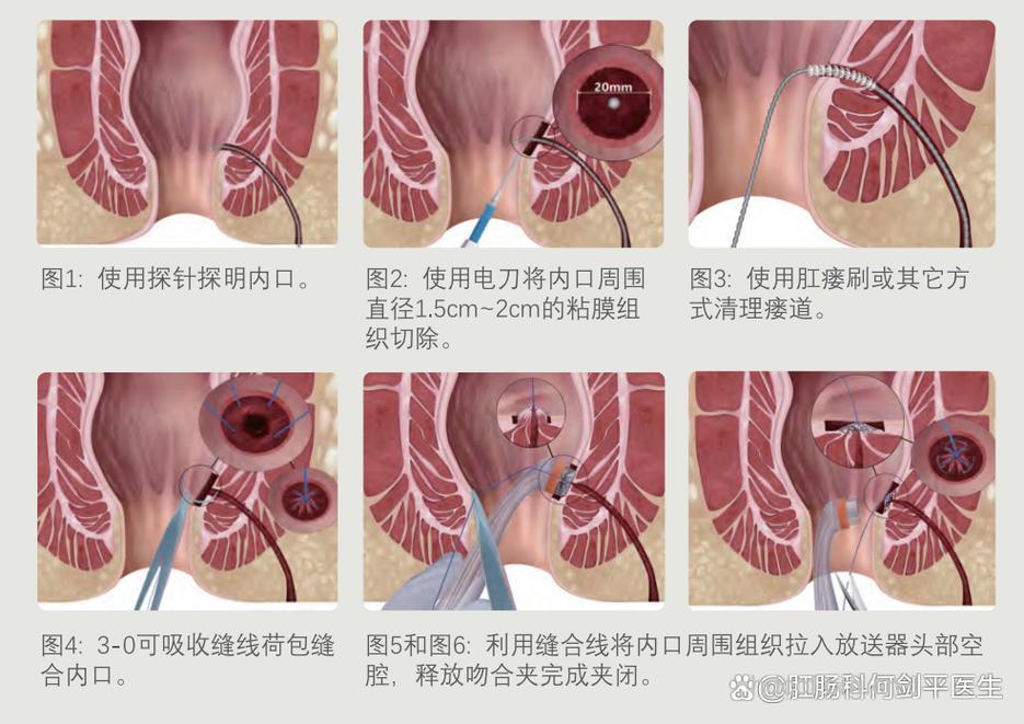 手术治疗肛瘘的方法