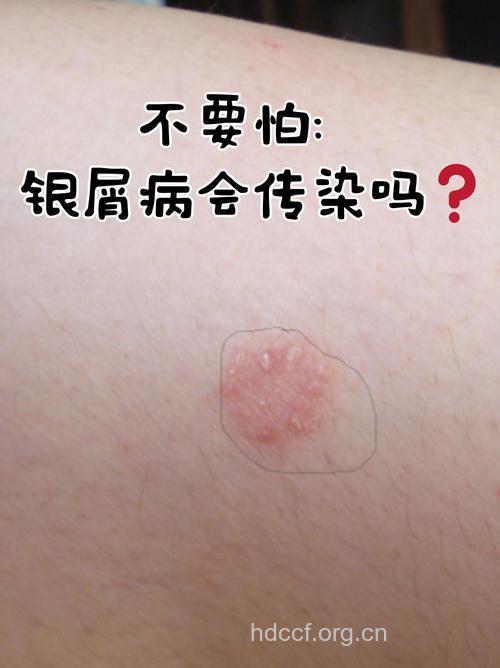 银屑病到底会不会传染?