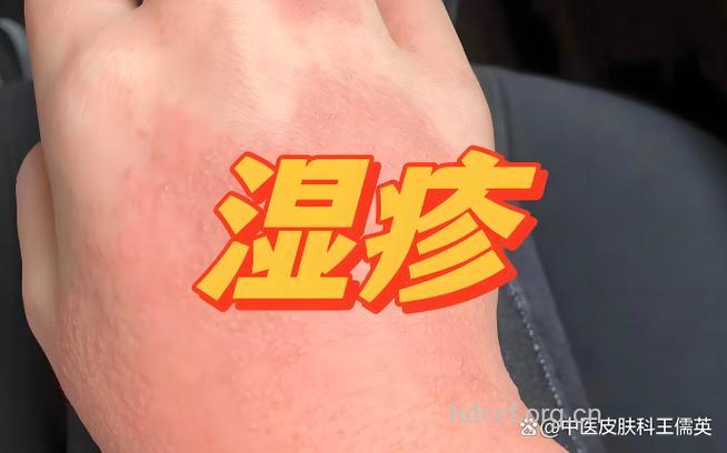 煲电话粥，竟惹出皮炎湿疹