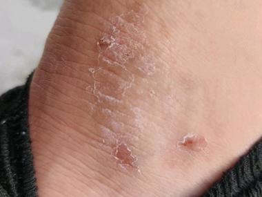 慢性湿疹的症状有何特点