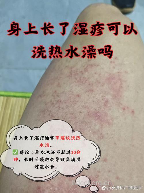 “每日一洗澡”容易患湿疹？