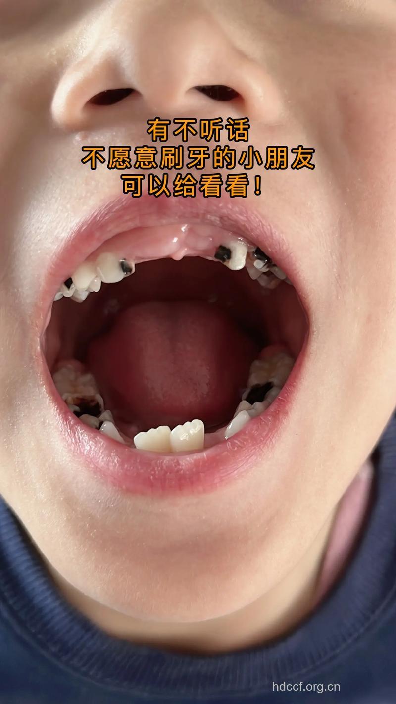 为什么孩子老是不爱刷牙
