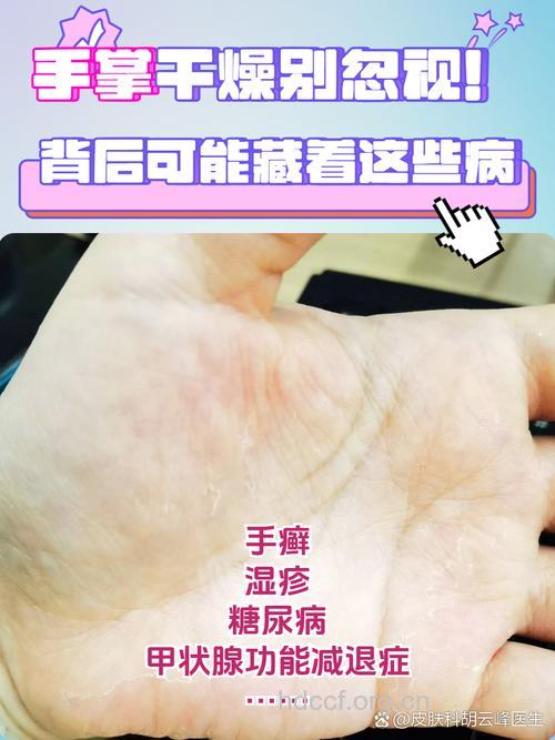 手部干燥性湿疹患者为何增加？