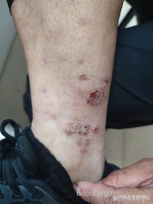 揭开湿疹的神秘面纱