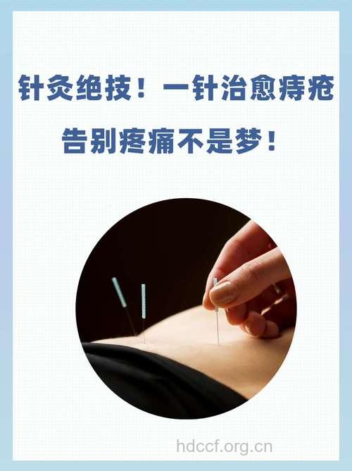 针灸疗法治疗痔疮