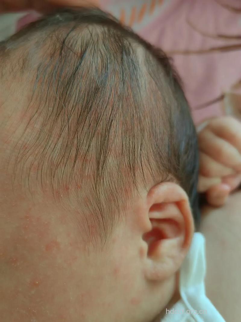 婴儿湿疹有多种症状