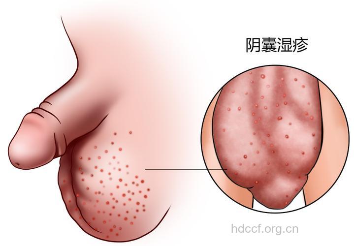阴囊湿疹最爱在夏季活动