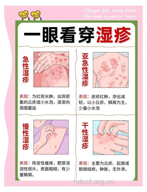 分类认识湿疹