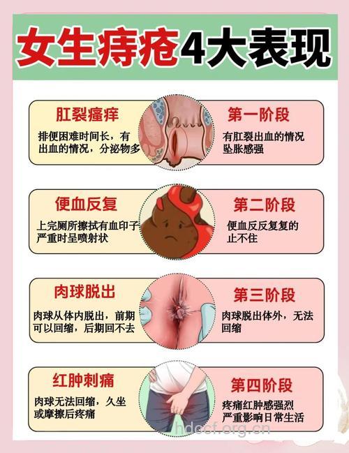 哪些人最容易患痔疮