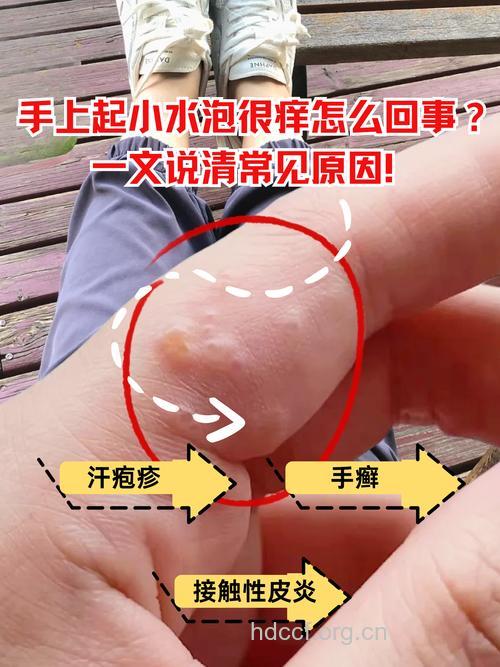 手上又开始出现小水疱