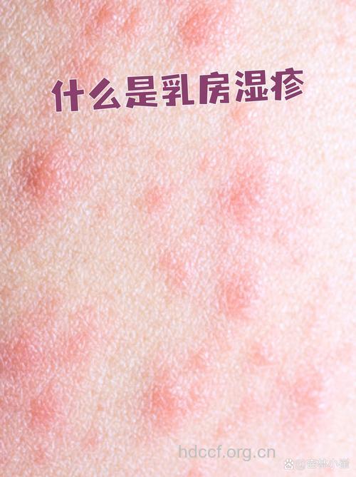 产后乳房防湿疹