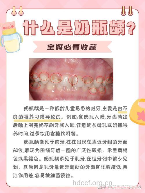 父母小心孩子奶瓶龋