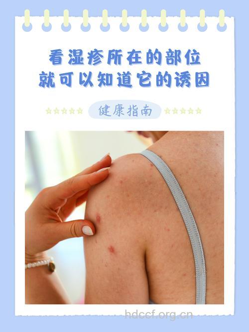 人体部位湿疹大搜集