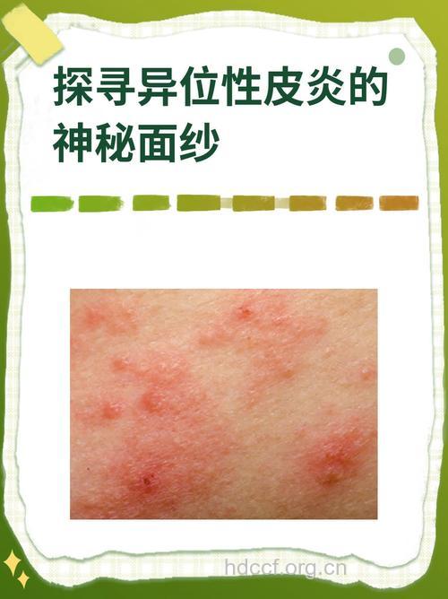 异位性皮炎的分期
