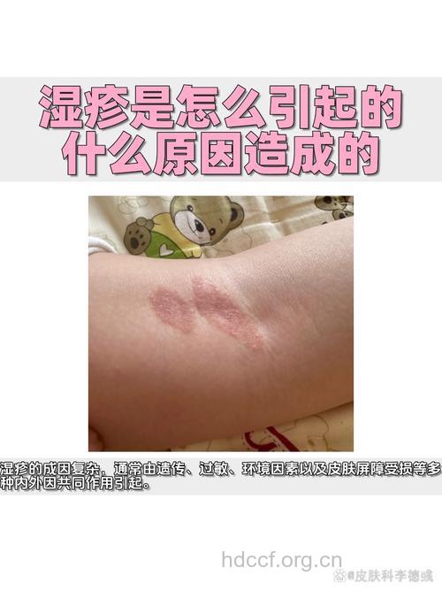 精神因素能导致湿疹的发生吗