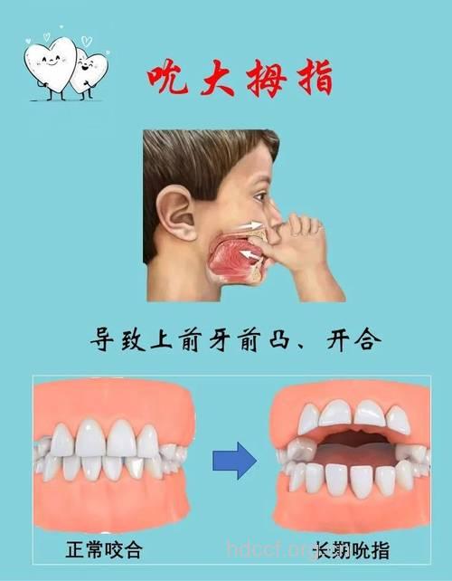 宝宝常吸允手指对口腔的危害