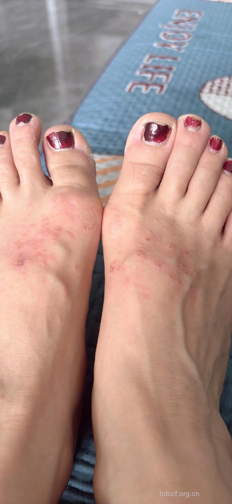 鞋子不透气易引发湿疹