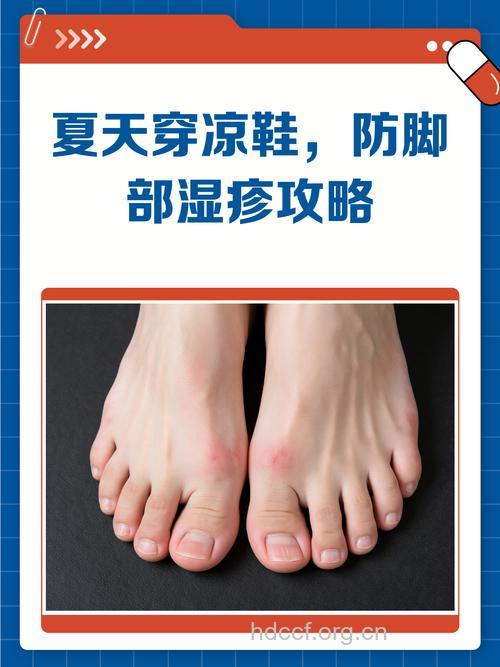 穿透气鞋子 预防湿疹