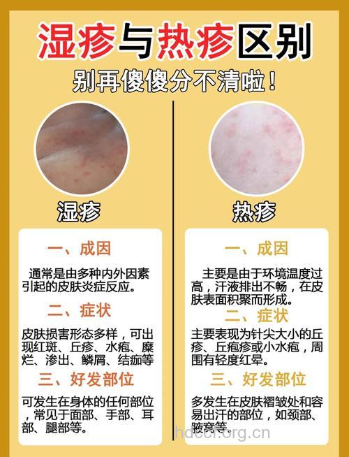 认识湿疹的4大误区