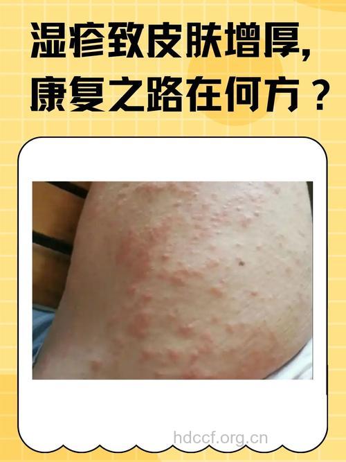 工作压力大易造成湿疹 是真的么？