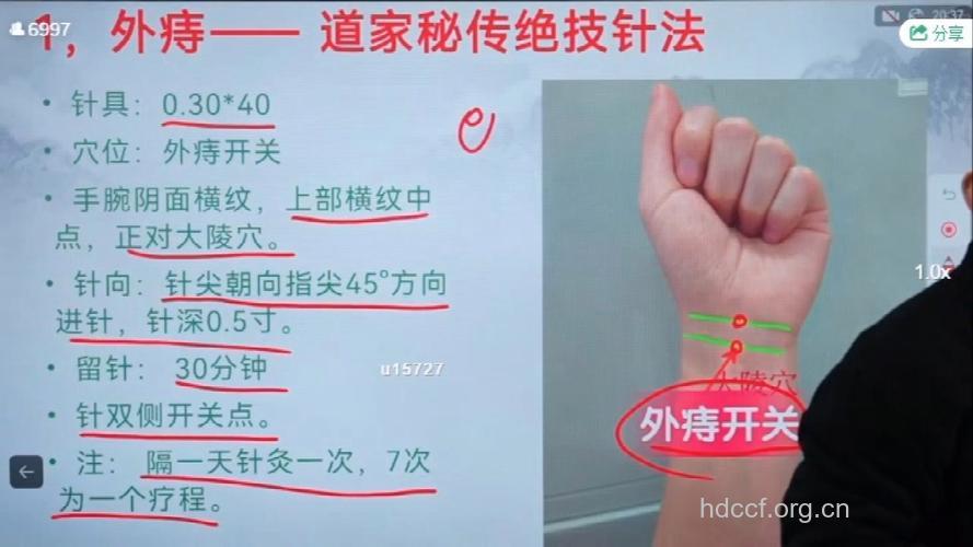 痔疮如何进行针灸治疗