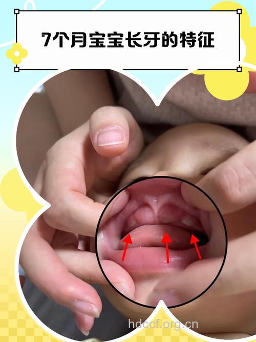 喂养姿势不对影响宝宝牙齿发育