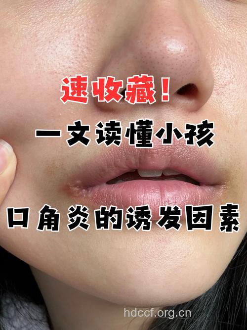 哪些因素诱发小儿唇裂