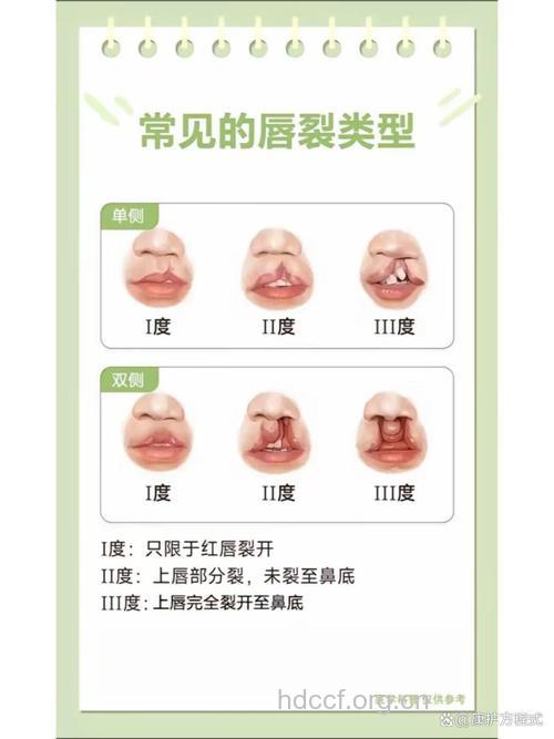 怎么手术治疗先天性唇裂