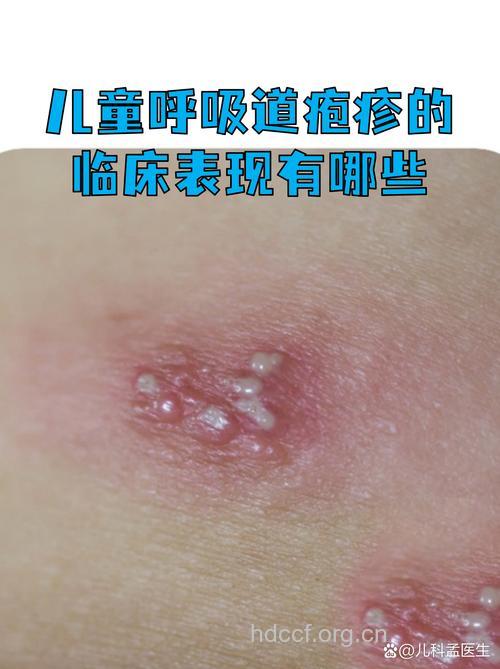 疱疹可能会传染儿童