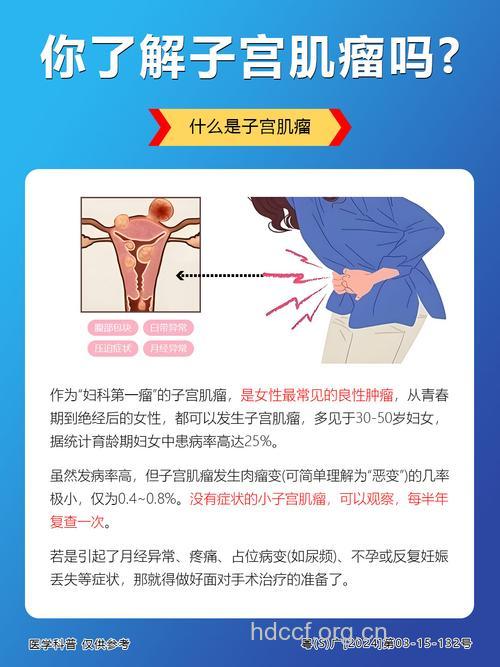 你知道什么是子宫肌瘤
