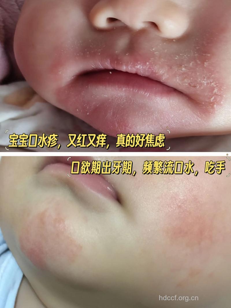 宝宝爱流口水可能招来湿疹