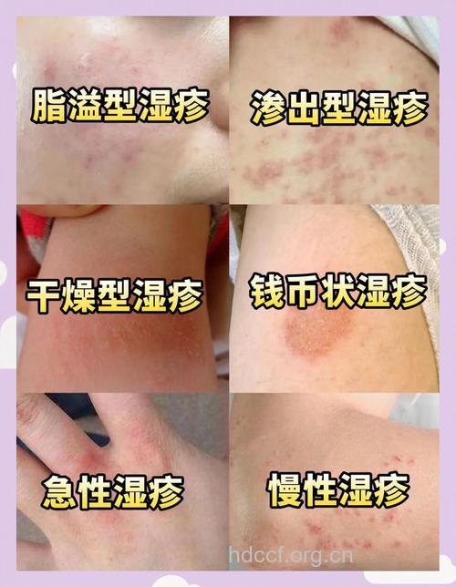 湿疹有哪些类型