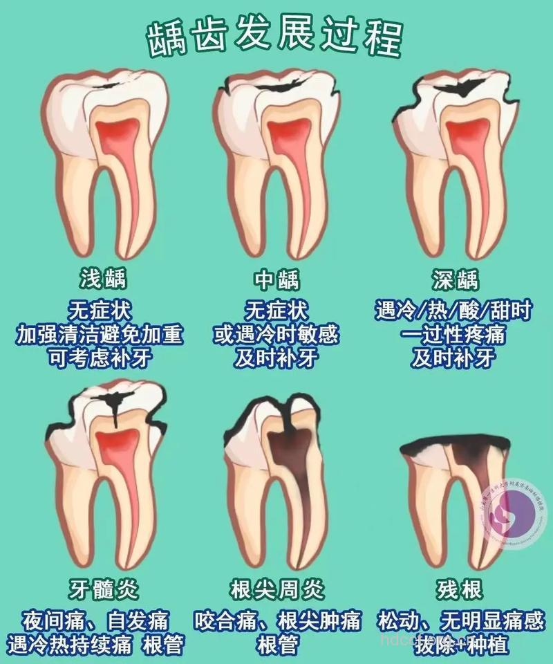 乳牙龋齿要治吗