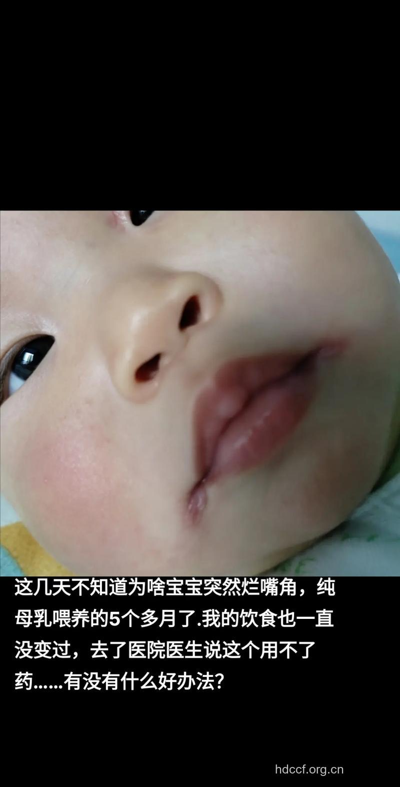 宝宝挑食易烂嘴角