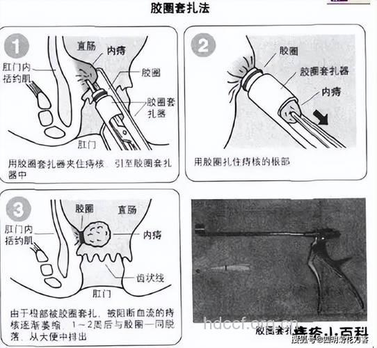 治疗痔疮有哪些非手术的方法
