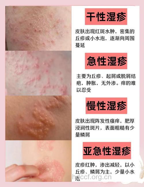 湿疹的症状有哪些?