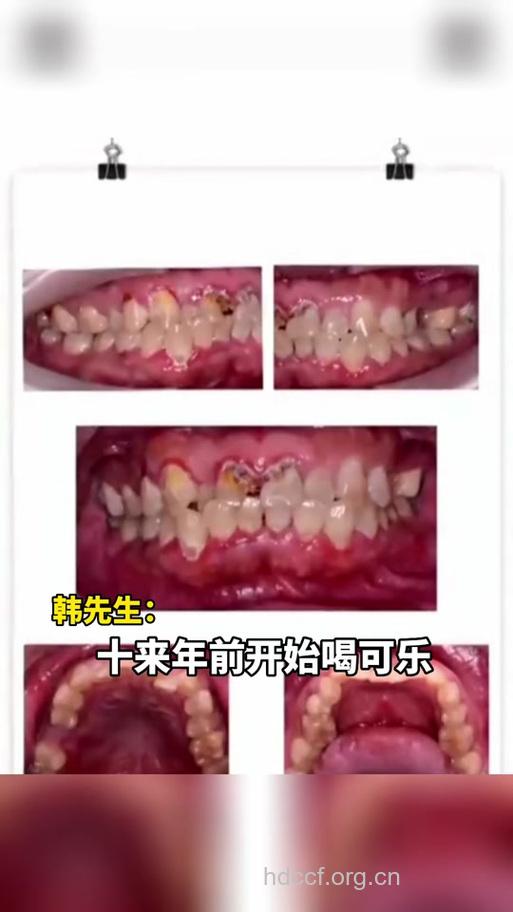 饮料毁牙“本事”大