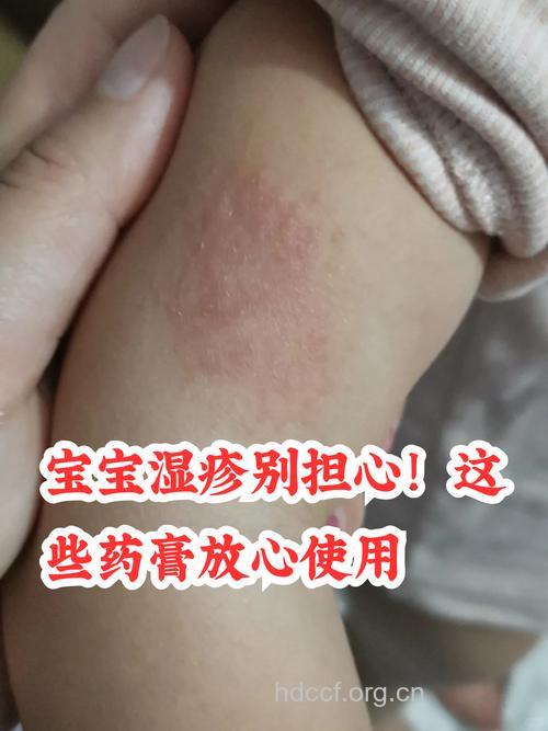 激素类药膏治疗婴儿湿疹，会引起性早熟么？