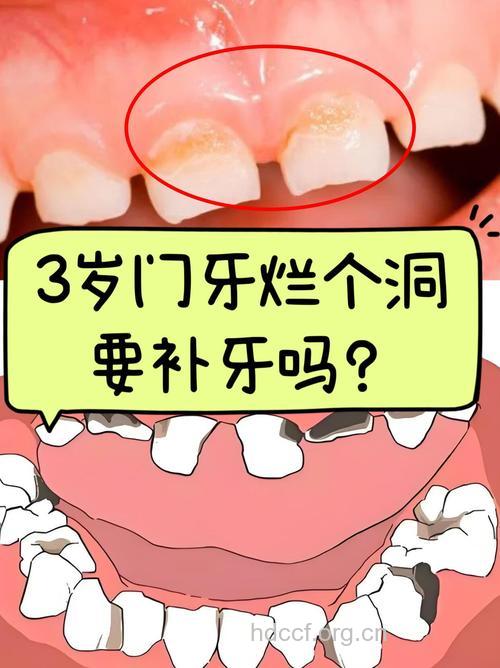 别小看孩子的乳牙疾病