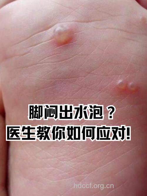 脚部起泡，需警惕湿疹