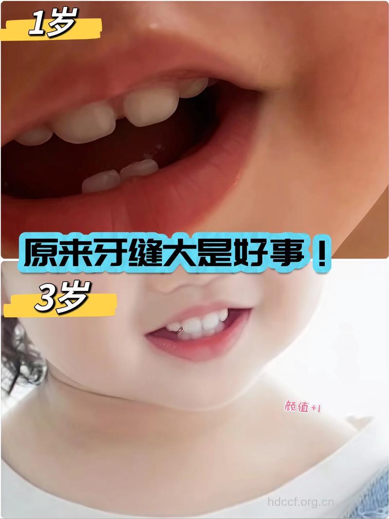 孩子的门牙过大不必慌