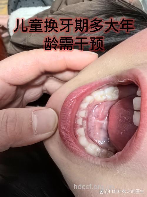 乳牙掉早了也得去医院