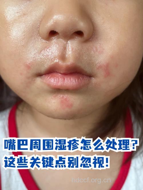 儿童嘴巴湿疹怎么办？