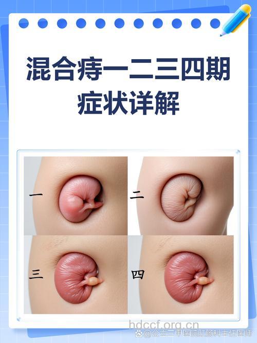 混合痔的症状表现