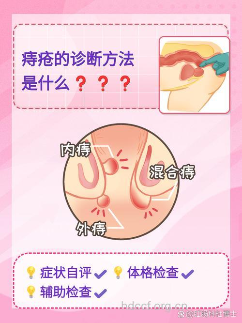 痔疮的确诊方法有哪些