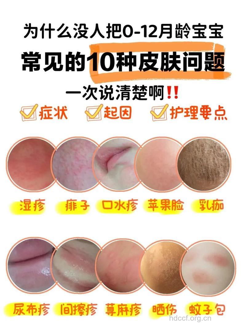 六步搞定婴儿湿疹！