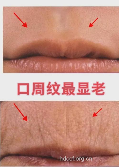 哪些坏习惯会导致皱纹